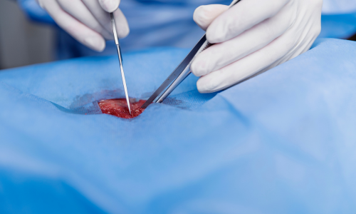 Laser Surgery
