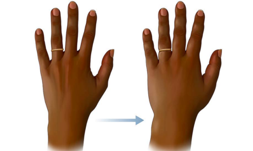 Body Swelling Treatment