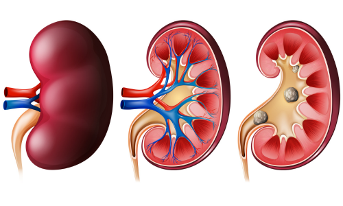 Kidney Stone Treatment