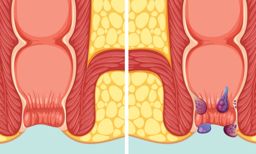 Fissure Treatment​